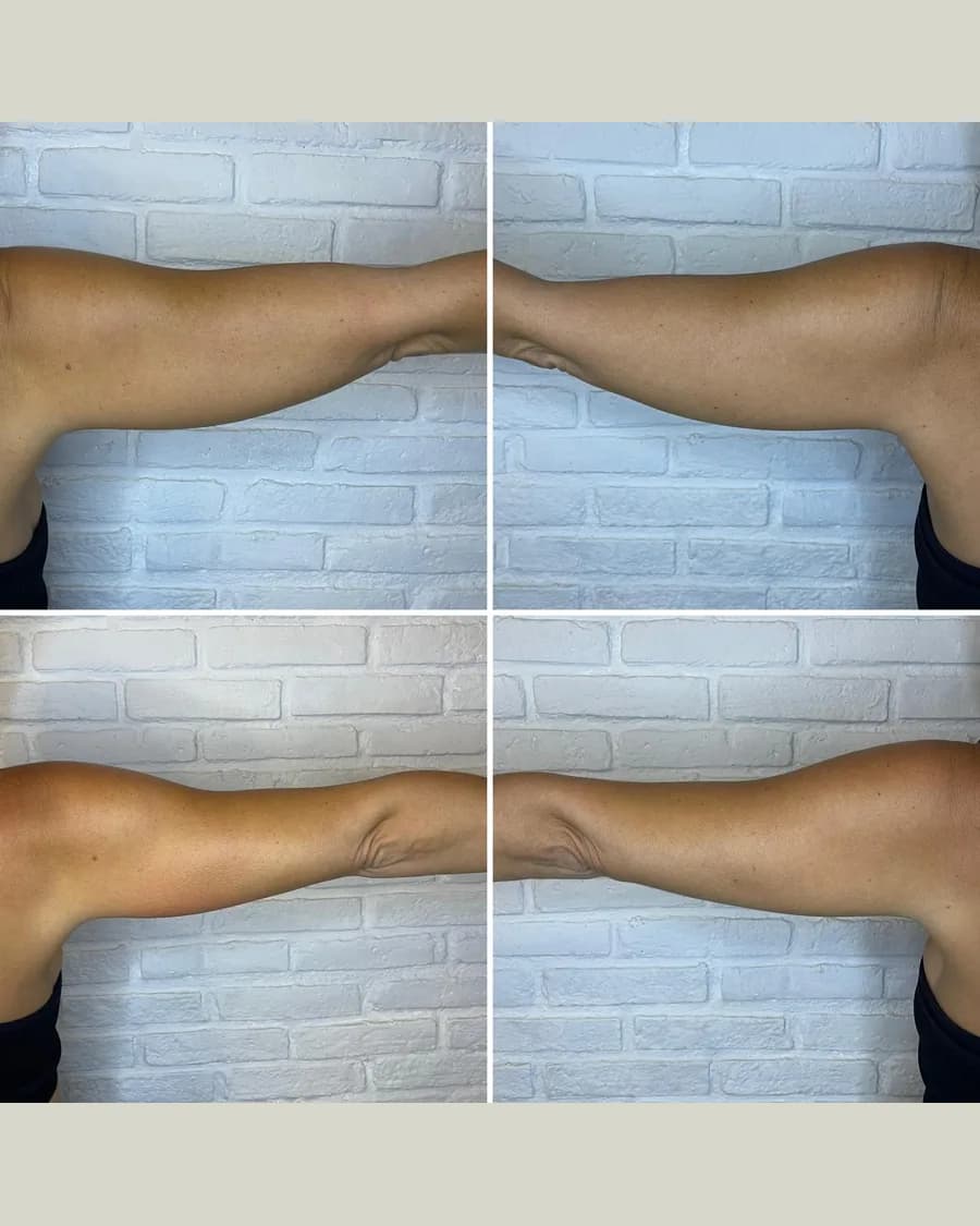 CryoSlimming Arms, 1 session: before-and-after result from Cryoskin Indonesia's own archive.
