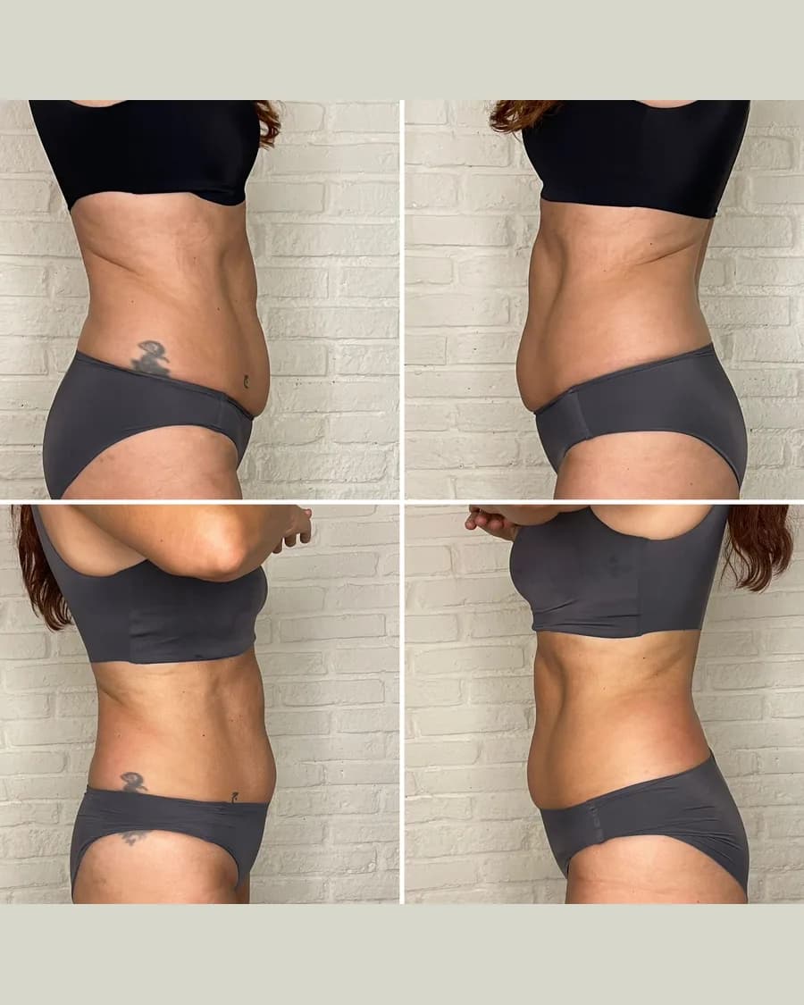 Slim & Sculpt, 1 session: before-and-after result from Cryoskin Indonesia's own archive.