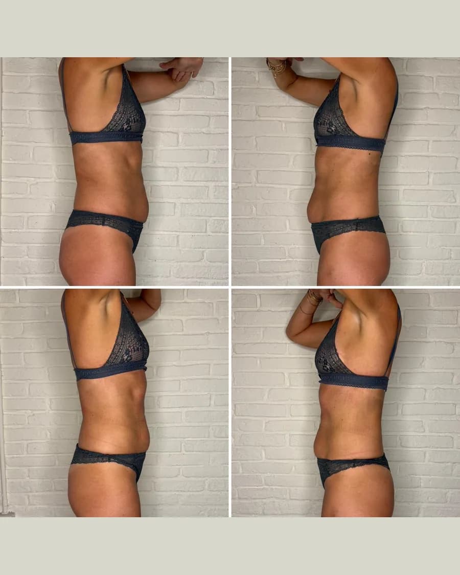 Slim & Sculpt, 1 session: before-and-after result from Cryoskin Indonesia's own archive.